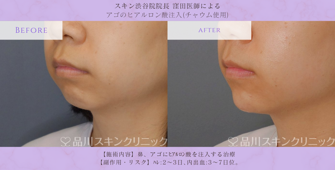 アゴヒアルロン酸 注入 症例 渋谷