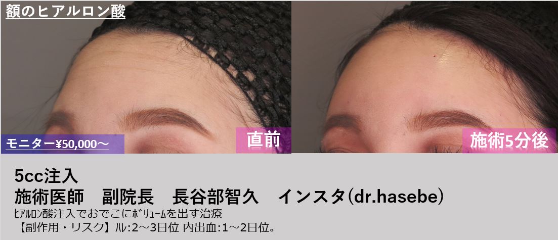 渋谷院 長谷部 智久医師によるヒアルロン酸による額出し 27 500 品川美容外科症例モニター募集 全国版