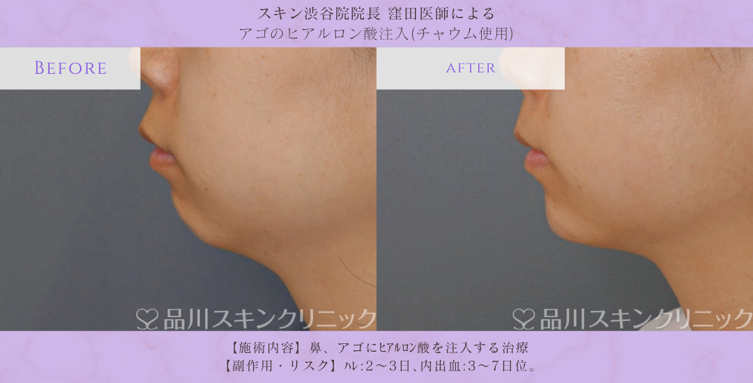 アゴヒアルロン酸 症例写真 品川スキンクリニック渋谷院