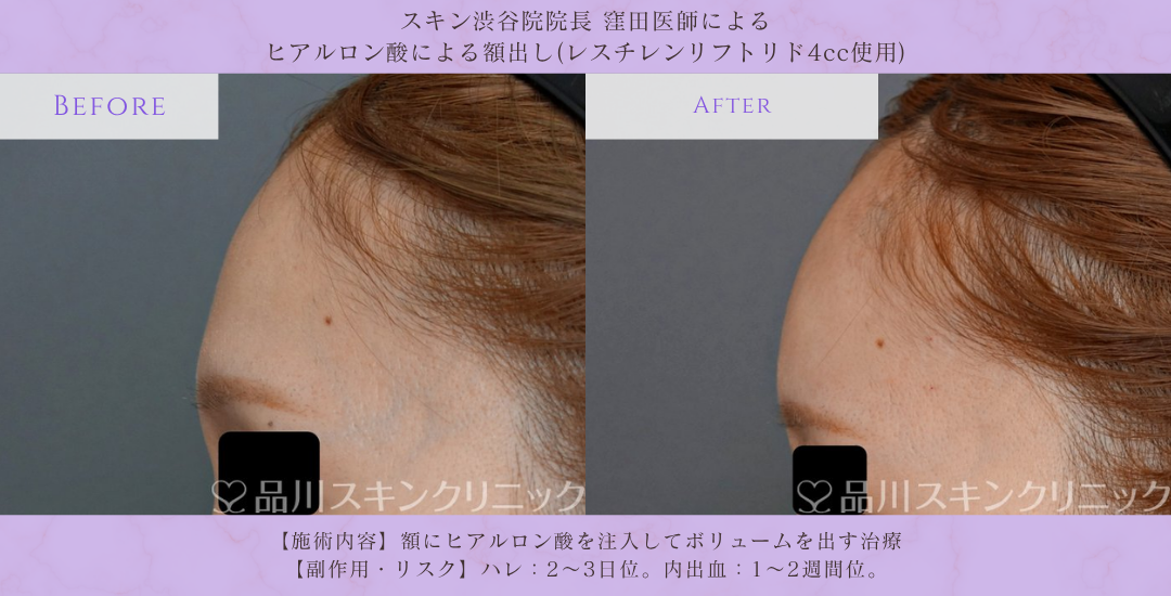 額ヒアルロン酸 男性 症例写真