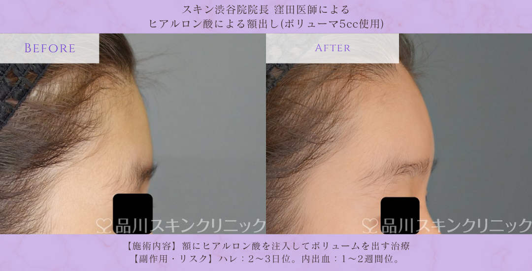 額ヒアルロン酸 自然な仕上がり 症例