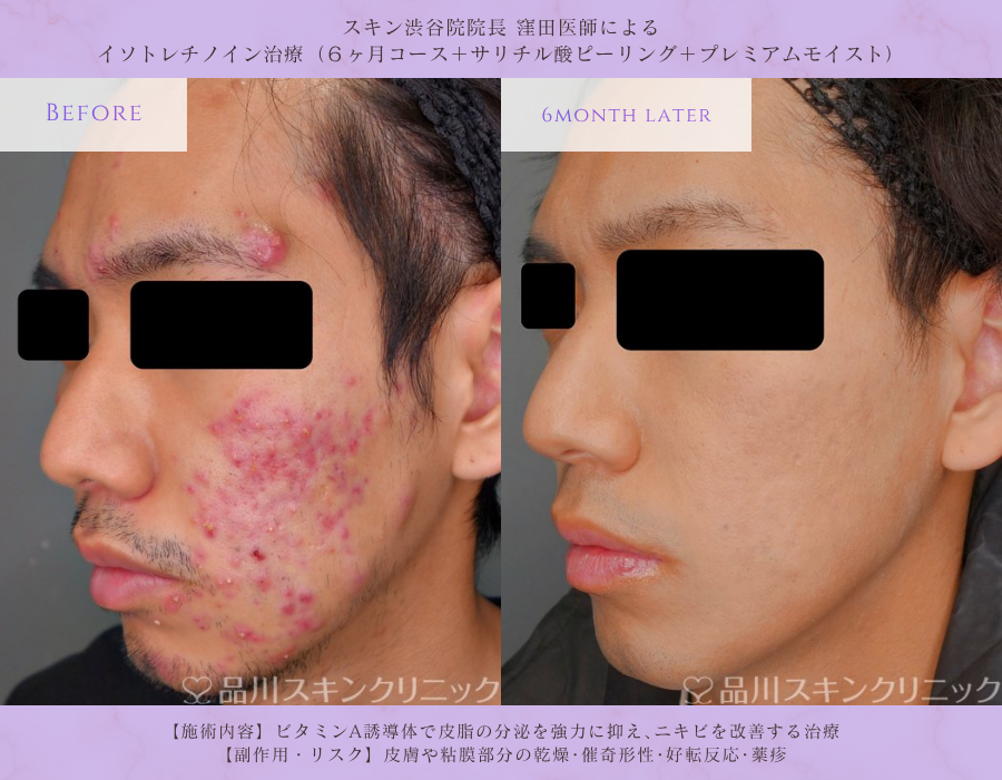 イソトレチノイン ビフォーアフター