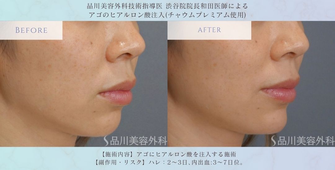 alt="アゴのヒアルロン酸注入 症例写真 術前"