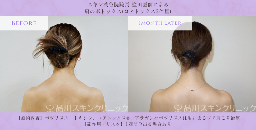 肩ボトックス 首肩ライン改善 症例