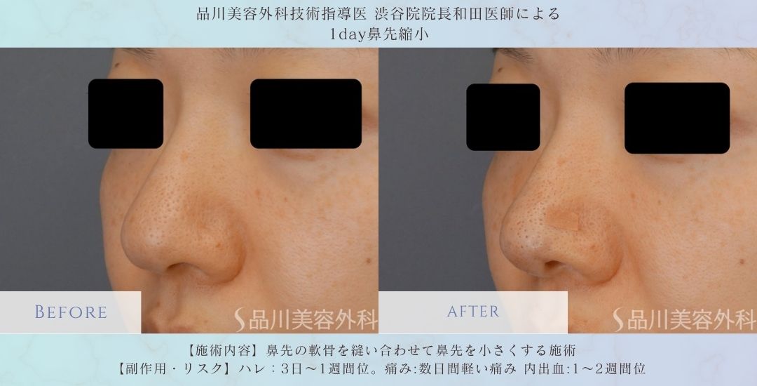 alt="1day鼻先縮小 症例写真 術後"