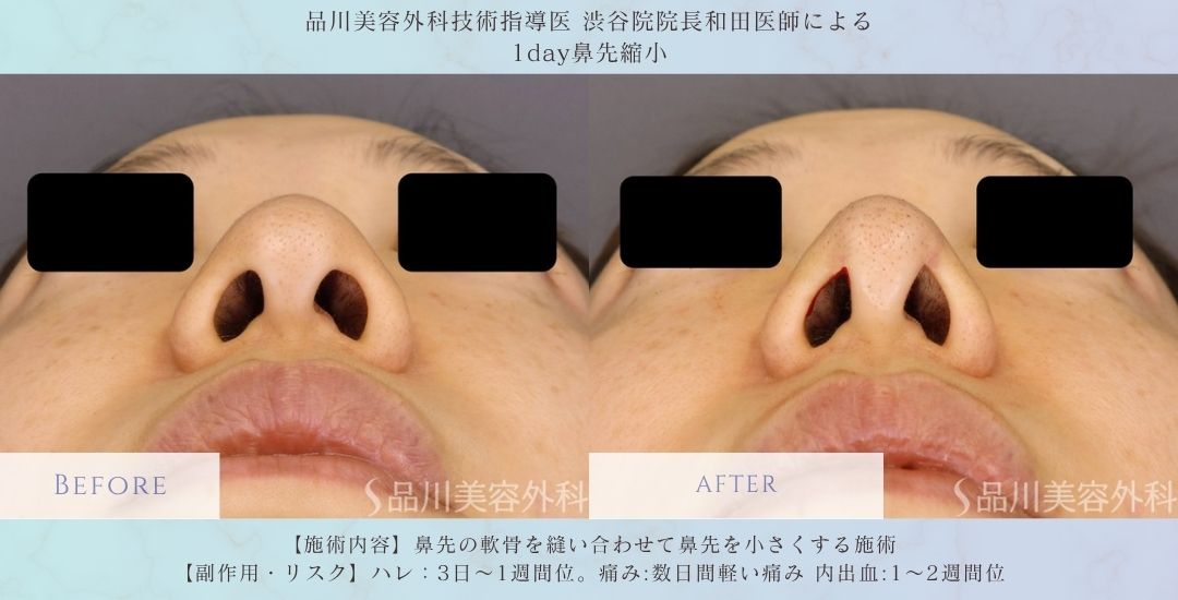 alt="1day鼻先縮小 症例写真 術前"