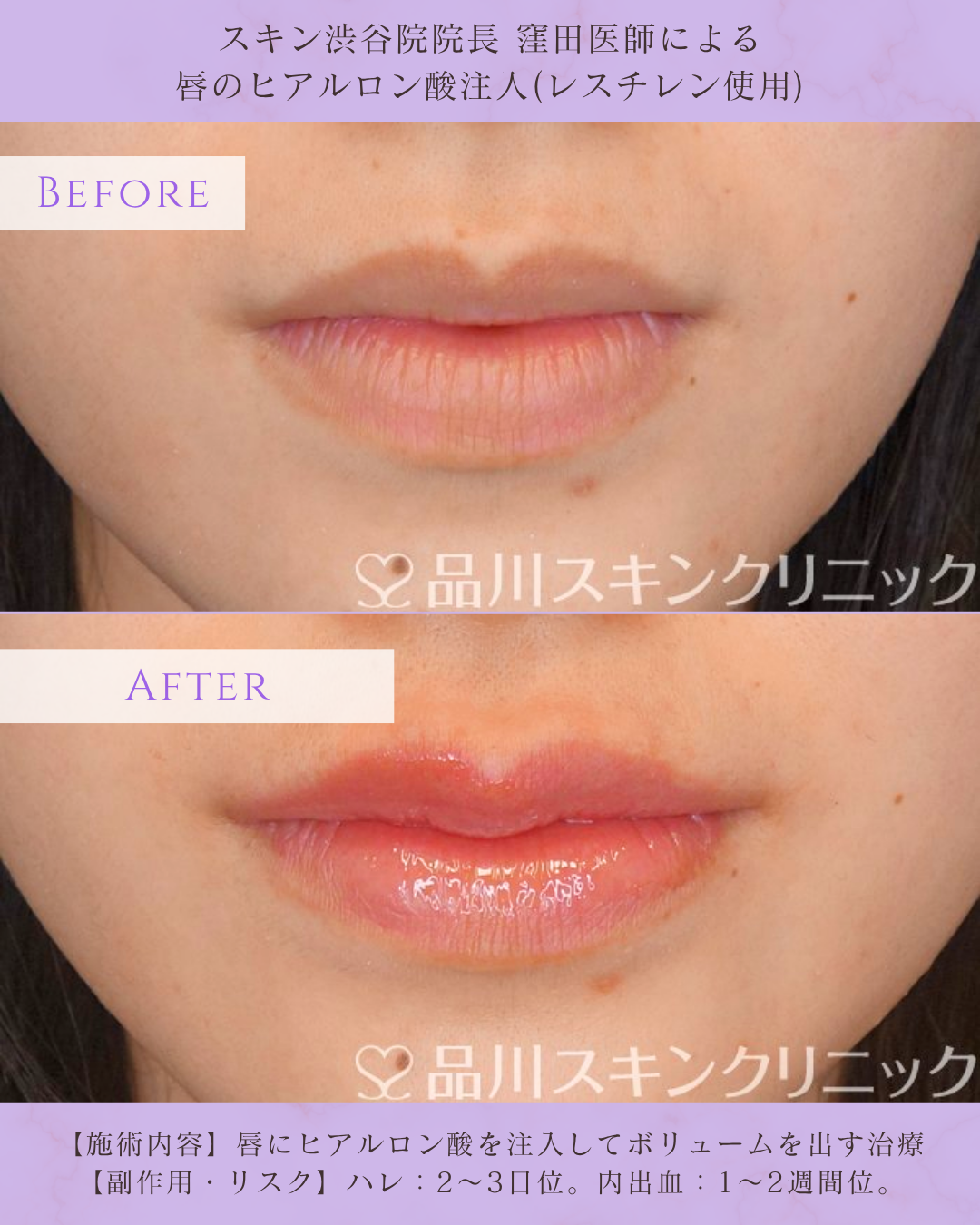 唇ヒアルロン酸 症例写真 品川スキンクリニック渋谷院