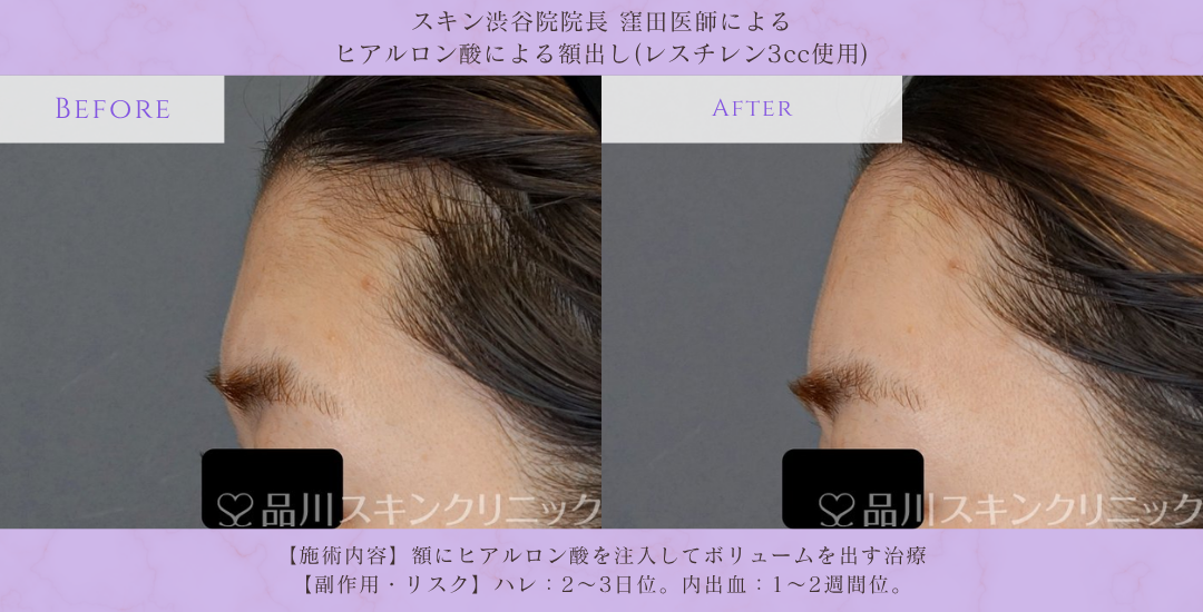 額ヒアルロン酸 モニター 症例写真