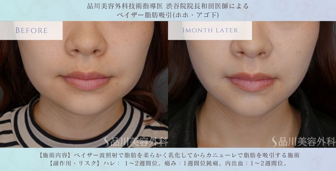 顔の脂肪吸引 症例写真 術前