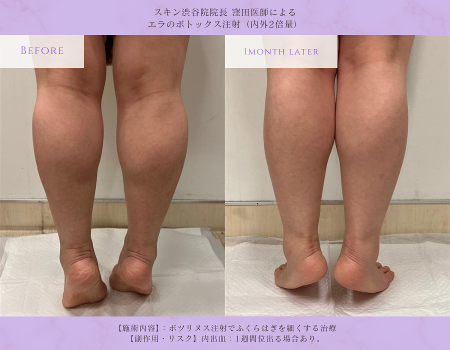 ふくらはぎボトックス ビフォーアフター 渋谷院