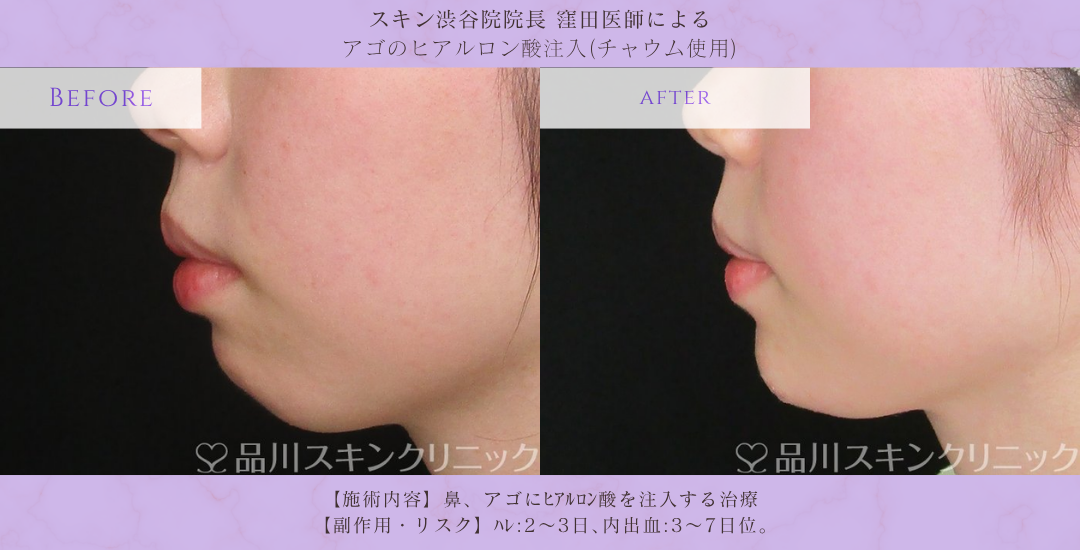 アゴヒアルロン酸 モニター 症例写真