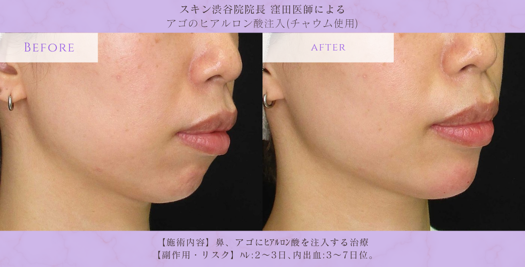 Eライン形成 ヒアルロン酸 症例