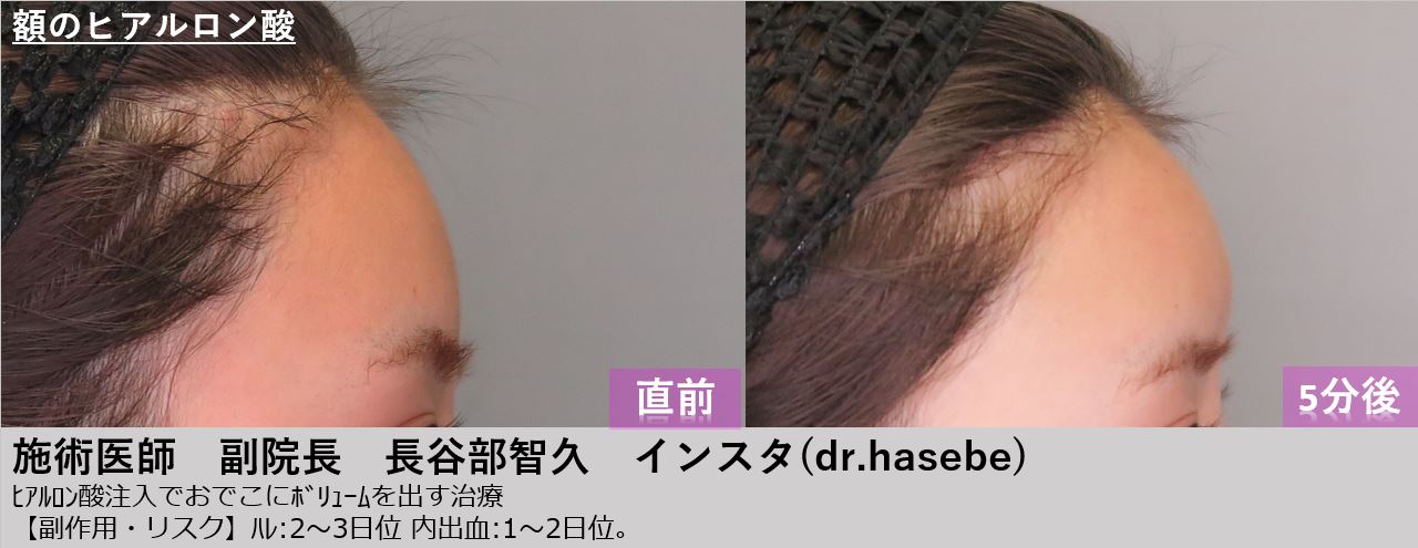 渋谷院 長谷部 智久医師によるヒアルロン酸による額出し 27 500 品川美容外科症例モニター募集 全国版