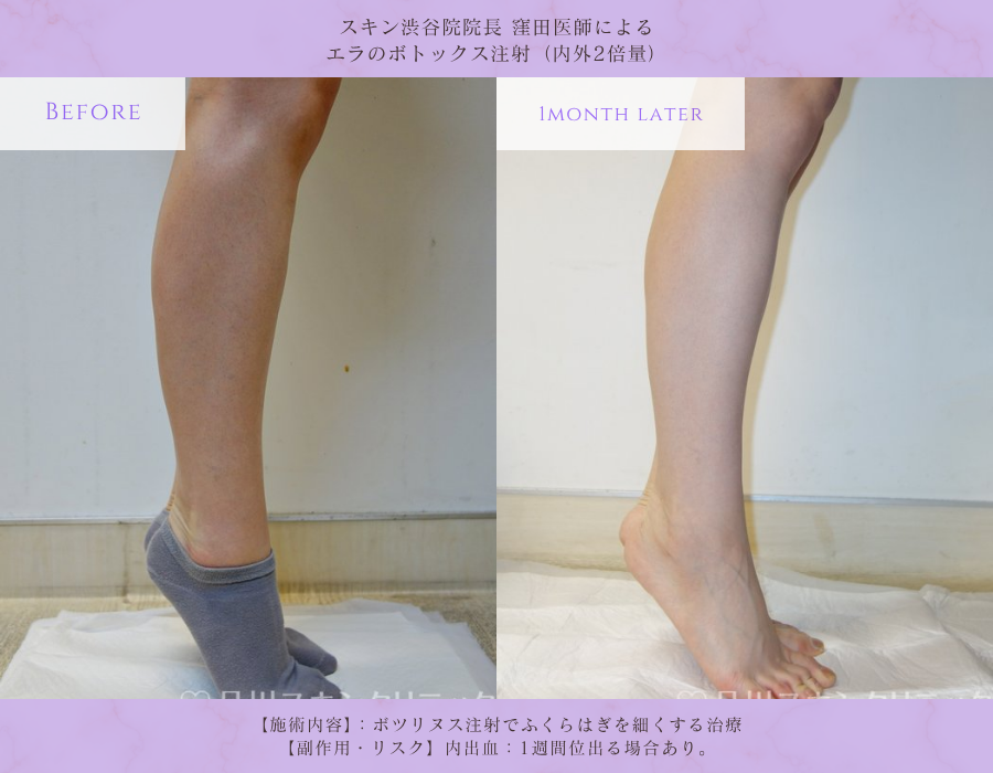 ふくらはぎボトックス 脚のライン改善 症例