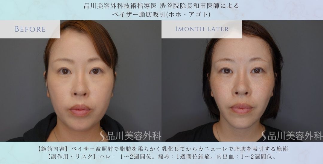 顔の脂肪吸引 フェイスライン改善 症例
