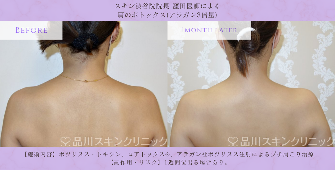 肩ボトックス 僧帽筋ボトックス 症例