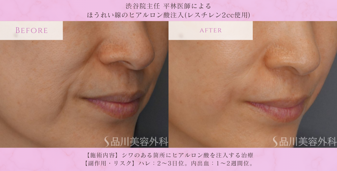 品川美容外科 渋谷院 ほうれい線ヒアルロン酸 症例
