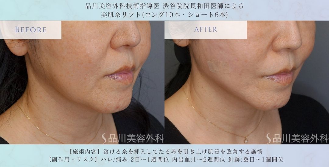 技術指導医による美肌糸リフト 症例