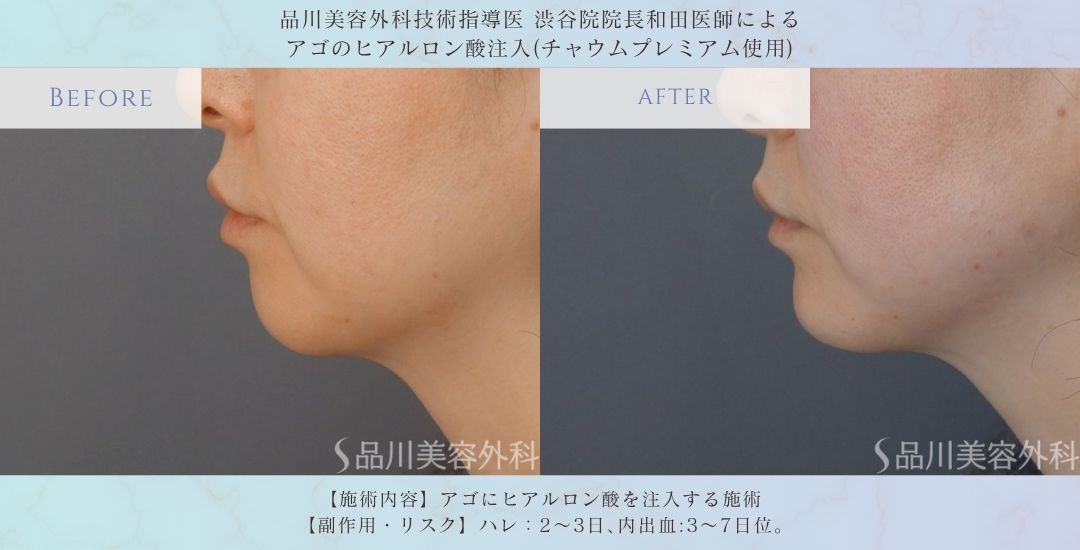 alt="アゴのヒアルロン酸注入 術前術後 比較 症例"