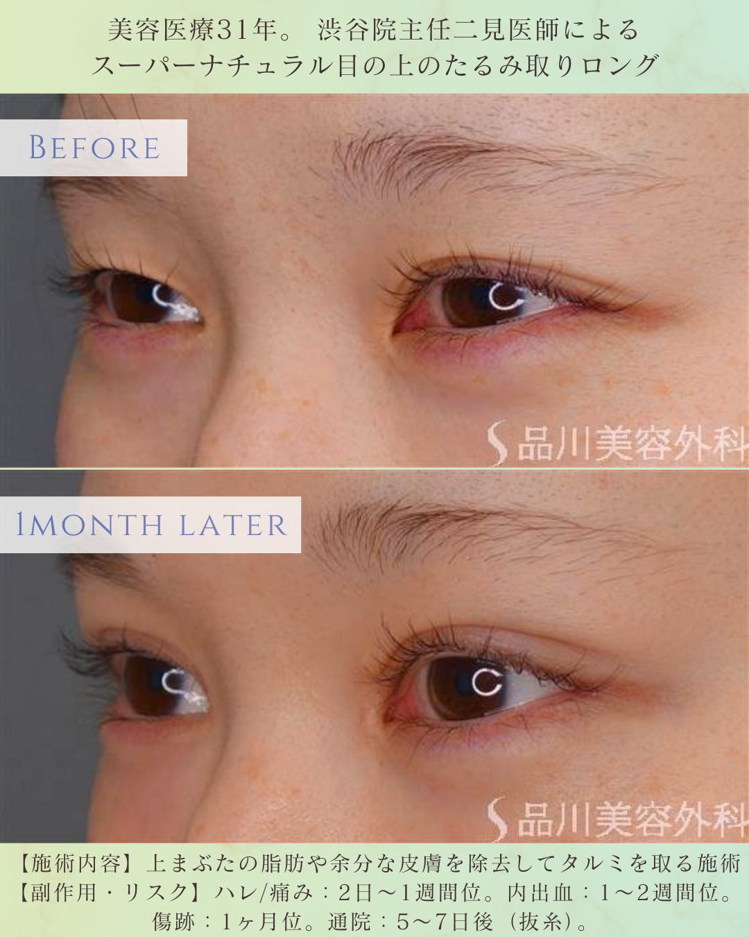 上まぶた たるみ改善 症例写真