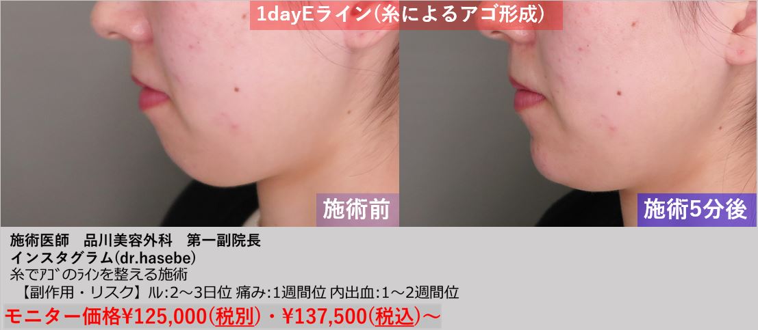 渋谷院 長谷部 智久医師による1day Eライン 137 500 品川美容外科症例モニター募集 全国版