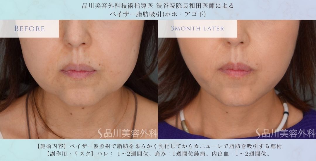 ホホ骨上 脂肪吸引 症例