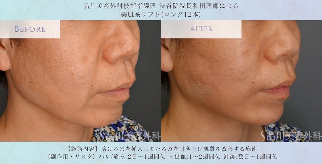 美肌糸リフト 症例写真 術後
