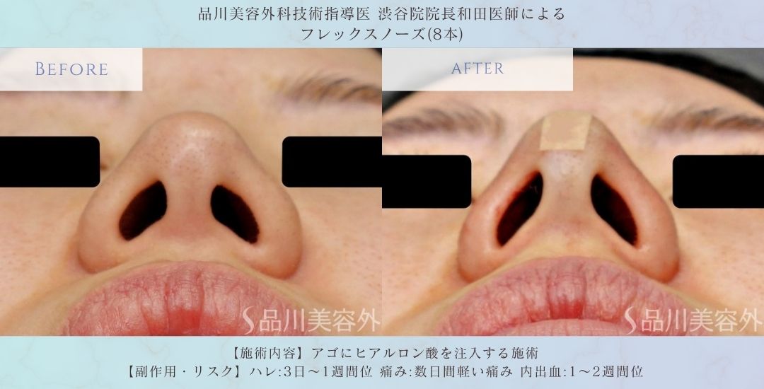 alt="フレックスノーズ 症例写真 術前"