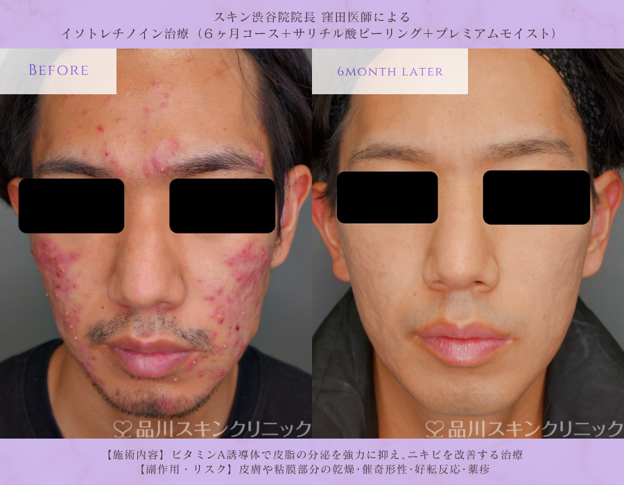 イソトレチノイン療法 症例写真 品川スキンクリニック渋谷院