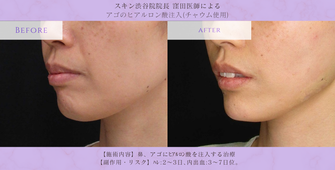 アゴヒアルロン酸 女性 症例