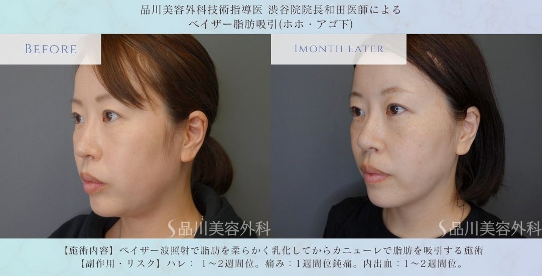 顔の脂肪吸引 小顔 症例写真