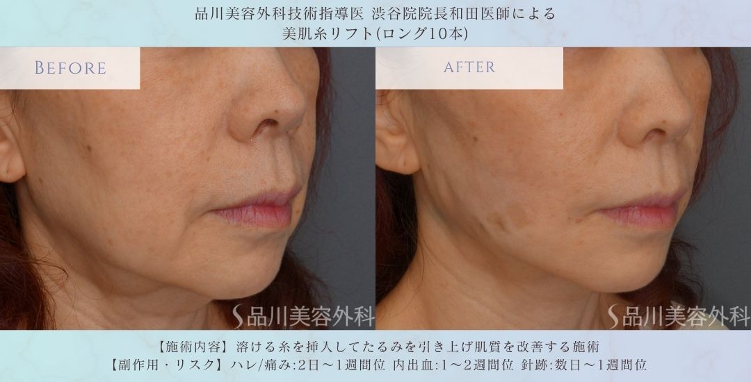 糸リフト ビフォーアフター 症例