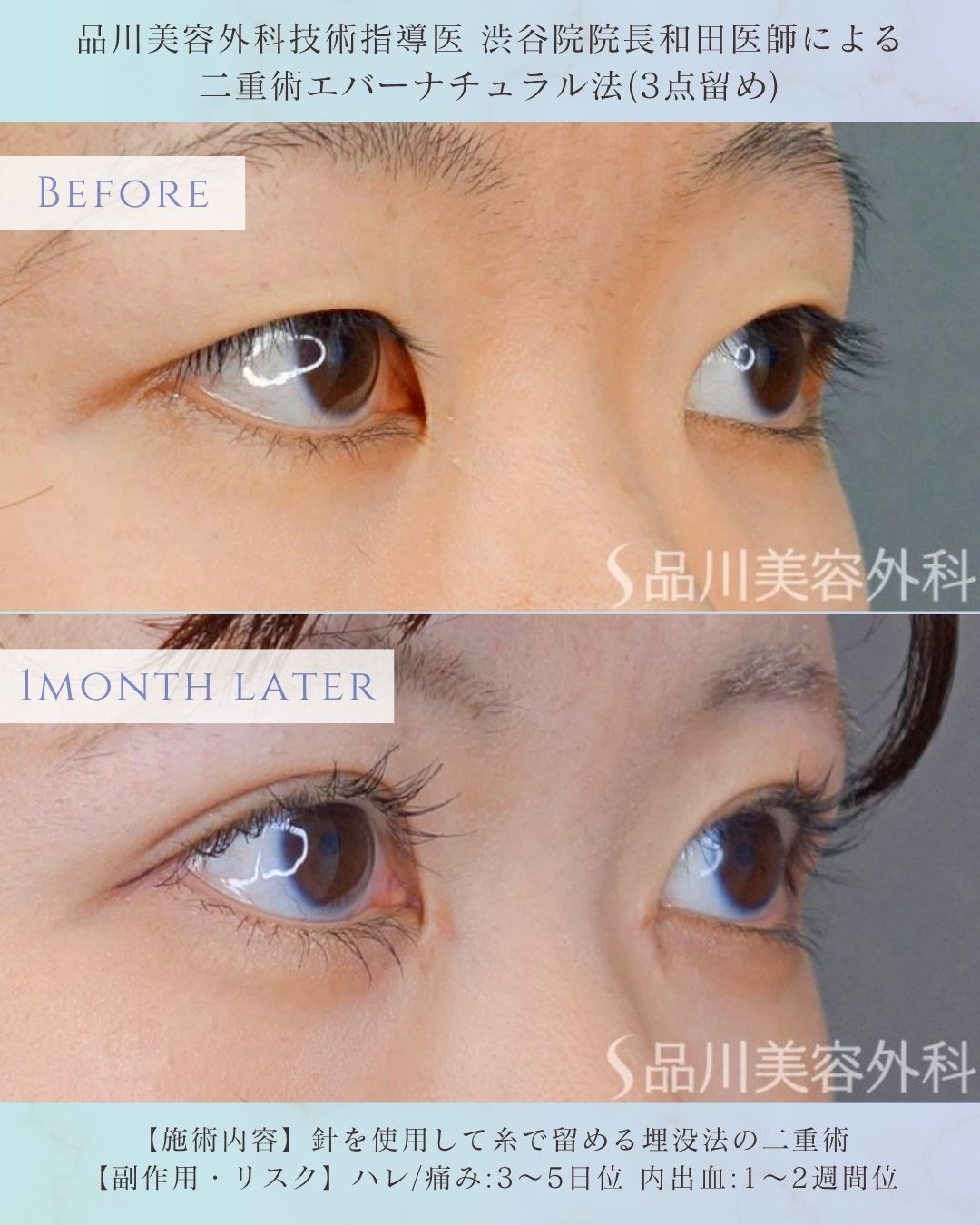 alt="二重埋没法 エバーナチュラル法 症例写真"