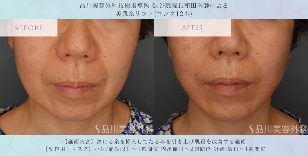 美肌糸リフト 症例写真 術前