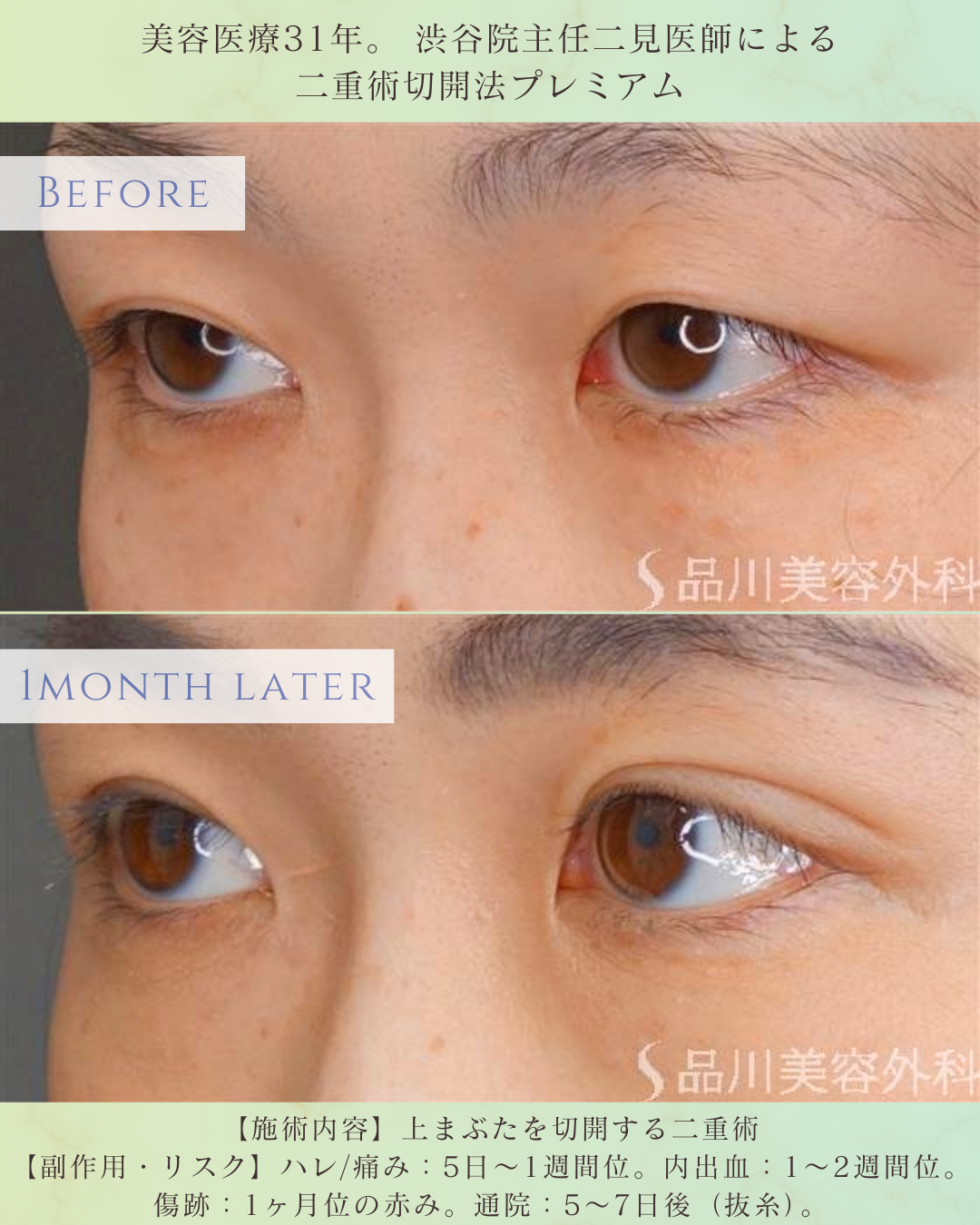 二重整形 切開法 ビフォーアフター