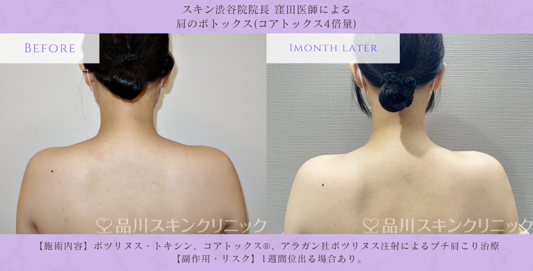 肩ボトックス ビフォーアフター 渋谷院