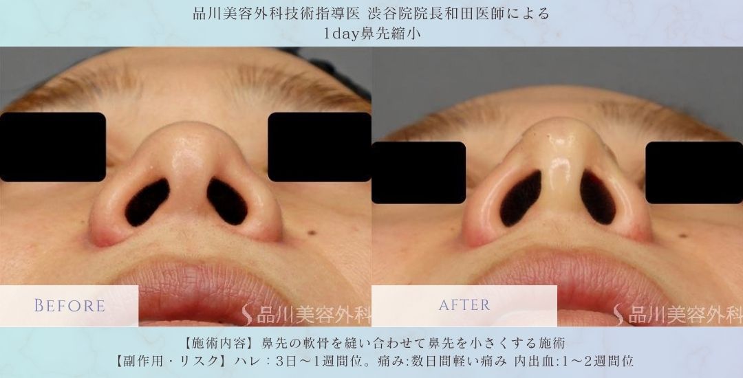 alt="鼻先の丸み改善 鼻先縮小 症例"