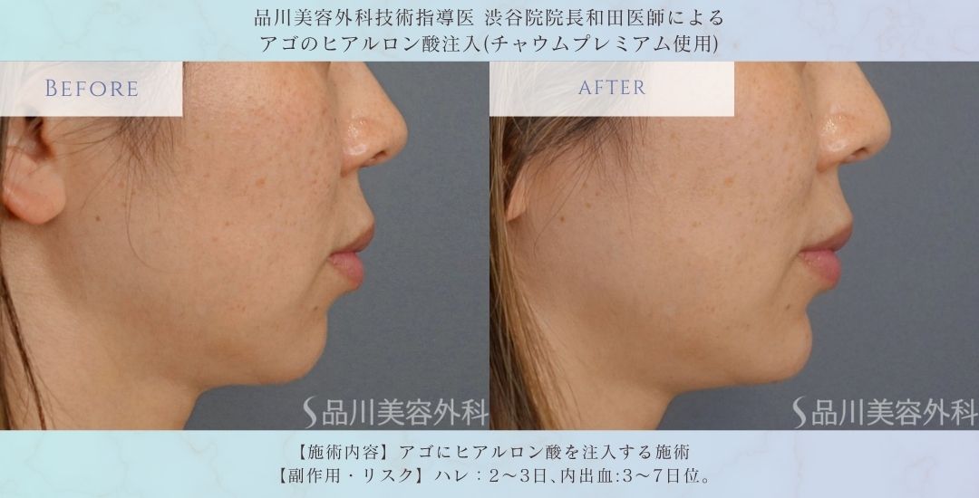 alt="アゴのヒアルロン酸注入 症例写真 術後"