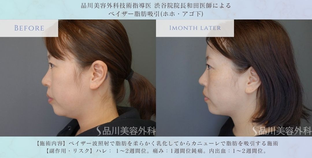 ホホ 脂肪吸引 症例