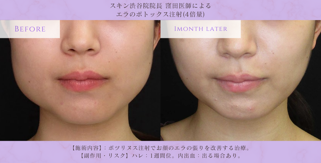 エラボトックス ビフォーアフター 渋谷院