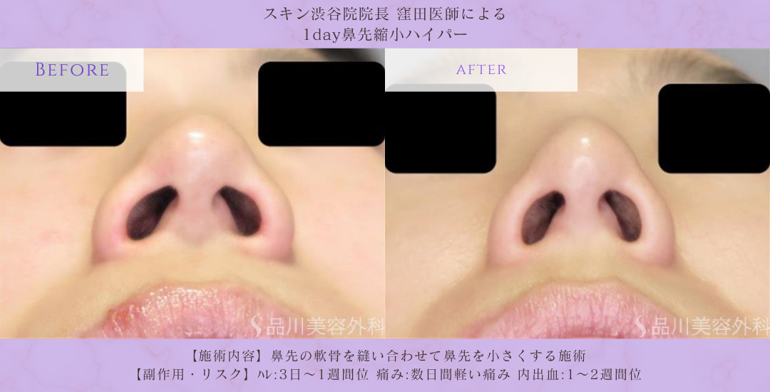 鼻先シャープ形成 症例