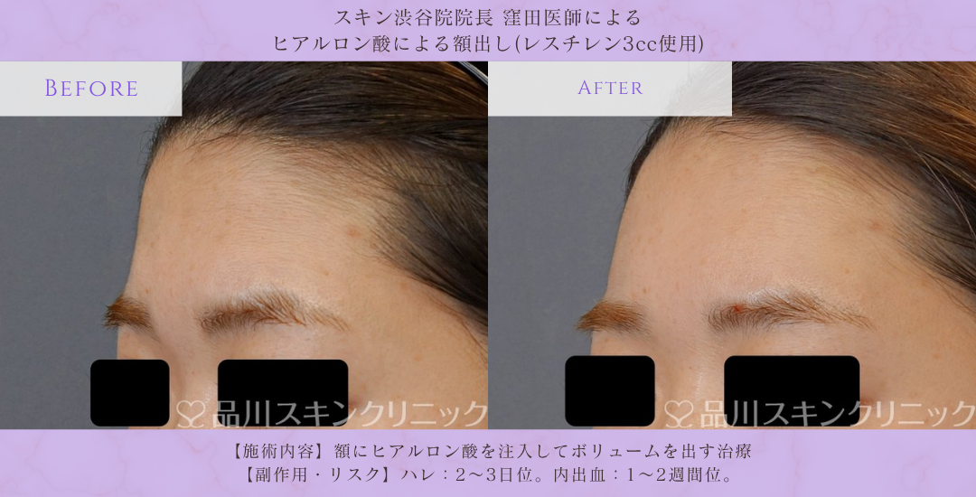 額出し ヒアルロン酸 ビフォーアフター