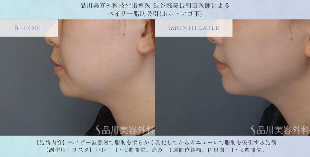 顔の脂肪吸引 術前術後 比較 症例