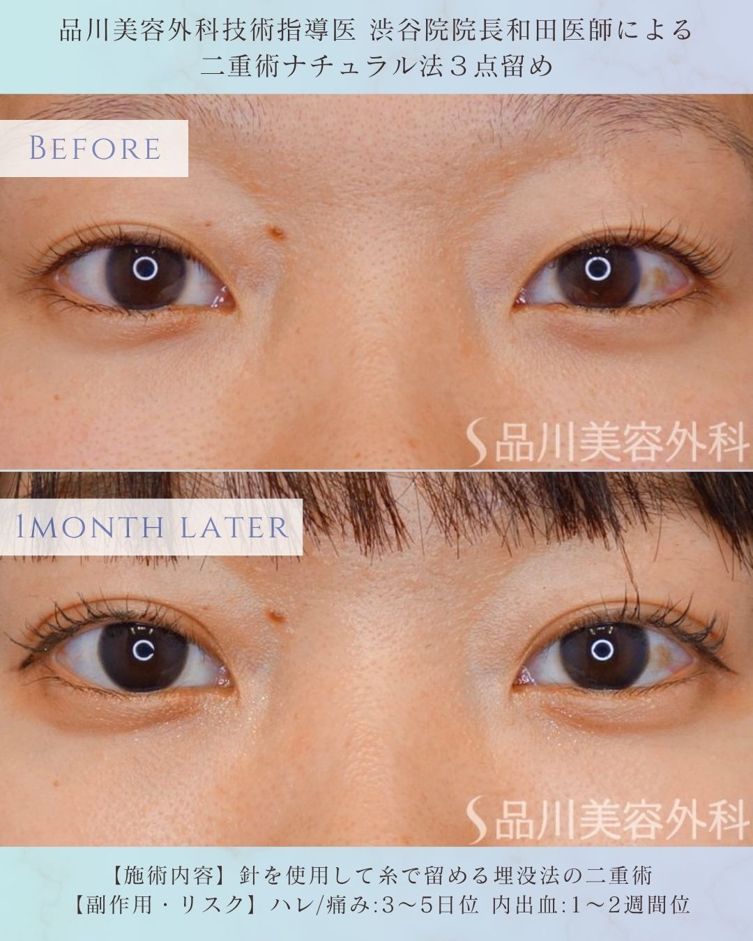 alt="二重術ナチュラル法 術前術後 比較 症例"