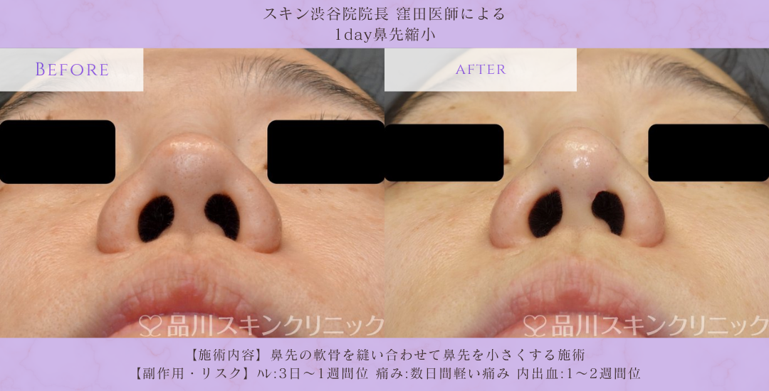 鼻先縮小 ビフォーアフター 渋谷院