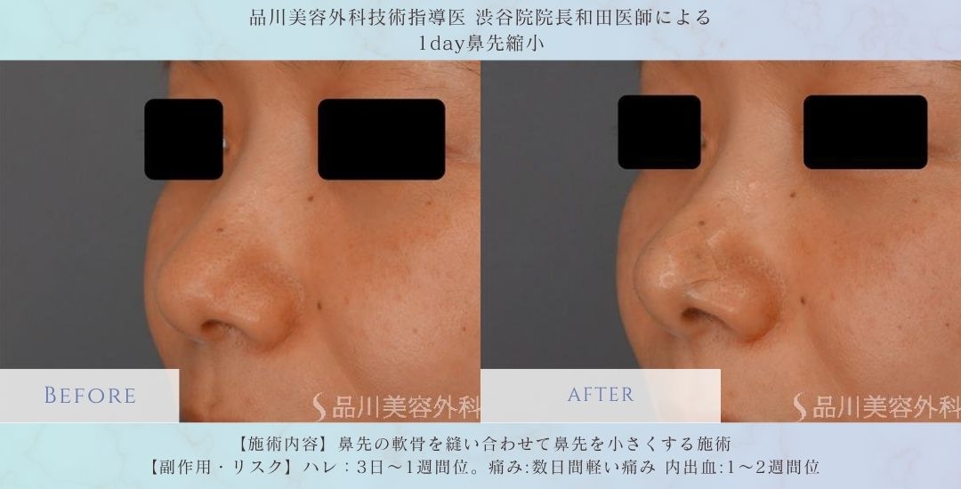 alt="鼻先をすっきり見せる 鼻整形 症例"