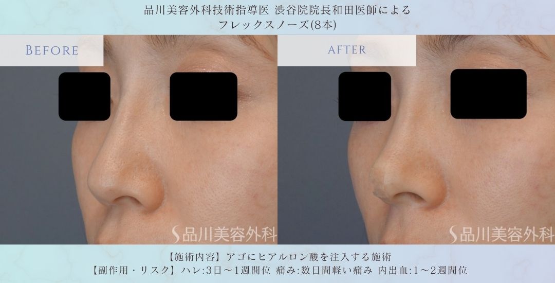 alt="フレックスノーズ 鼻整形 症例写真"