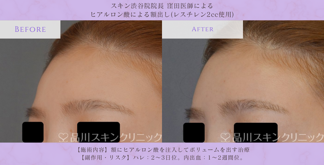 おでこ ヒアルロン酸 丸み形成 症例