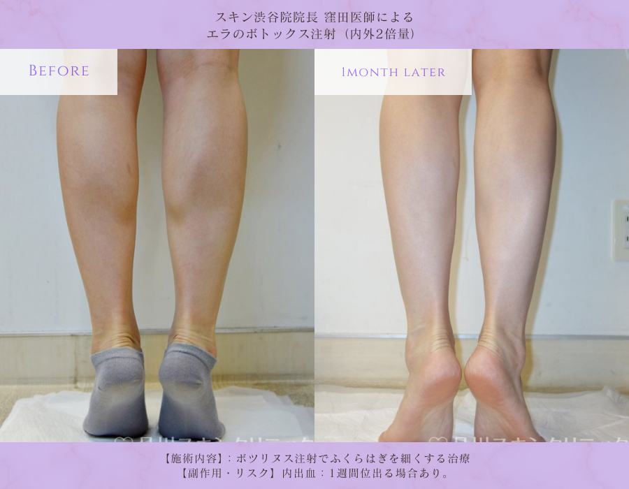 ふくらはぎボトックス モニター 症例写真