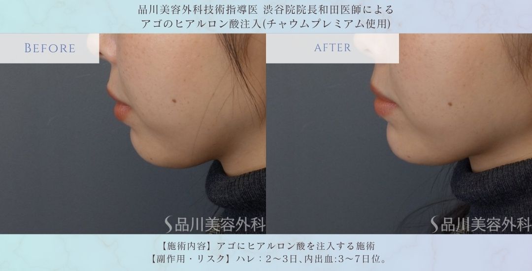 alt="チャウムプレミアム アゴヒアルロン酸 症例"